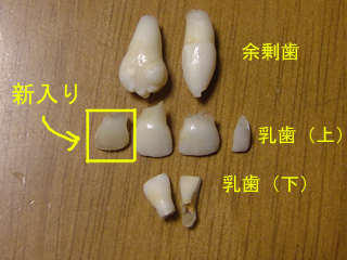 余剰歯でかいでしょ、抜くの超怖いＹＯ
